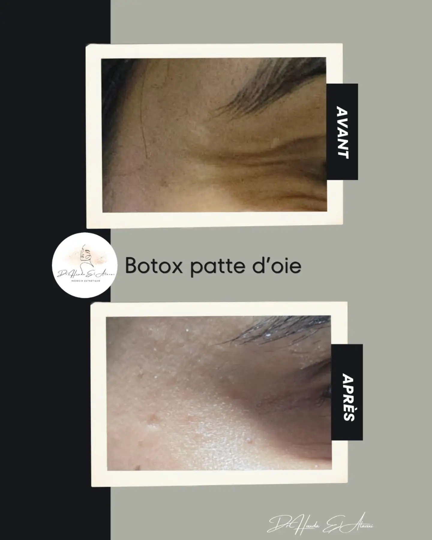 Résultat avant/après Botox patte d'oie, publié sur Instagram